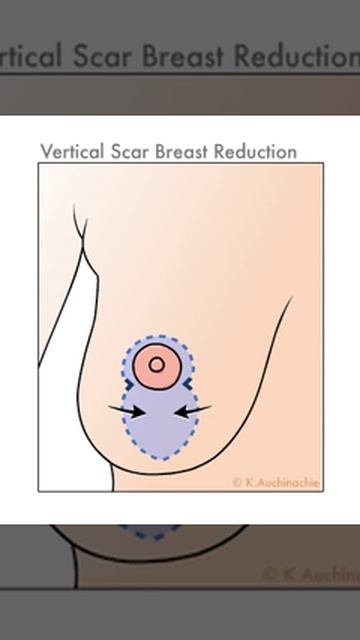 What is Breast Reduction? | Breast Reduction Demonstration | The Plastic Surgery Clinic смотреть онлайн