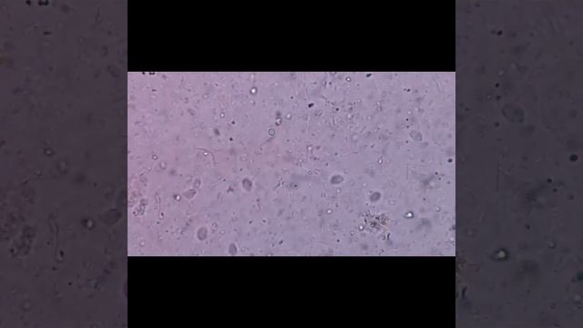 Numerous Live Parasites in Stool Microscopy смотреть онлайн