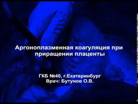 Плацента Акрета