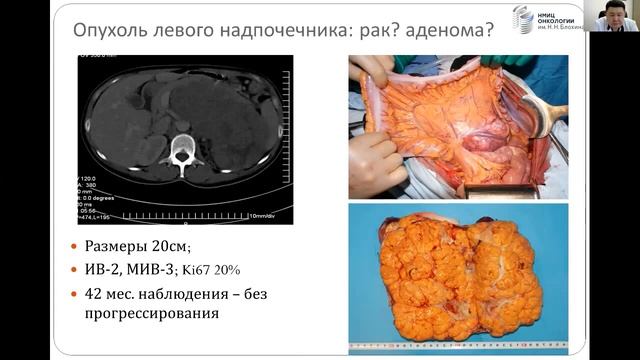 Научно образовательный онлайн вебинар по АКР адренокортикальный рак смотреть онлайн