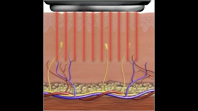 Laser Skin Renewal and Revitalization with Max G ICON @ CosMedic LaserMD смотреть онлайн