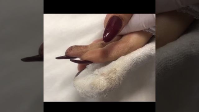 Повреждение сухожилий сгибателей смотреть онлайн