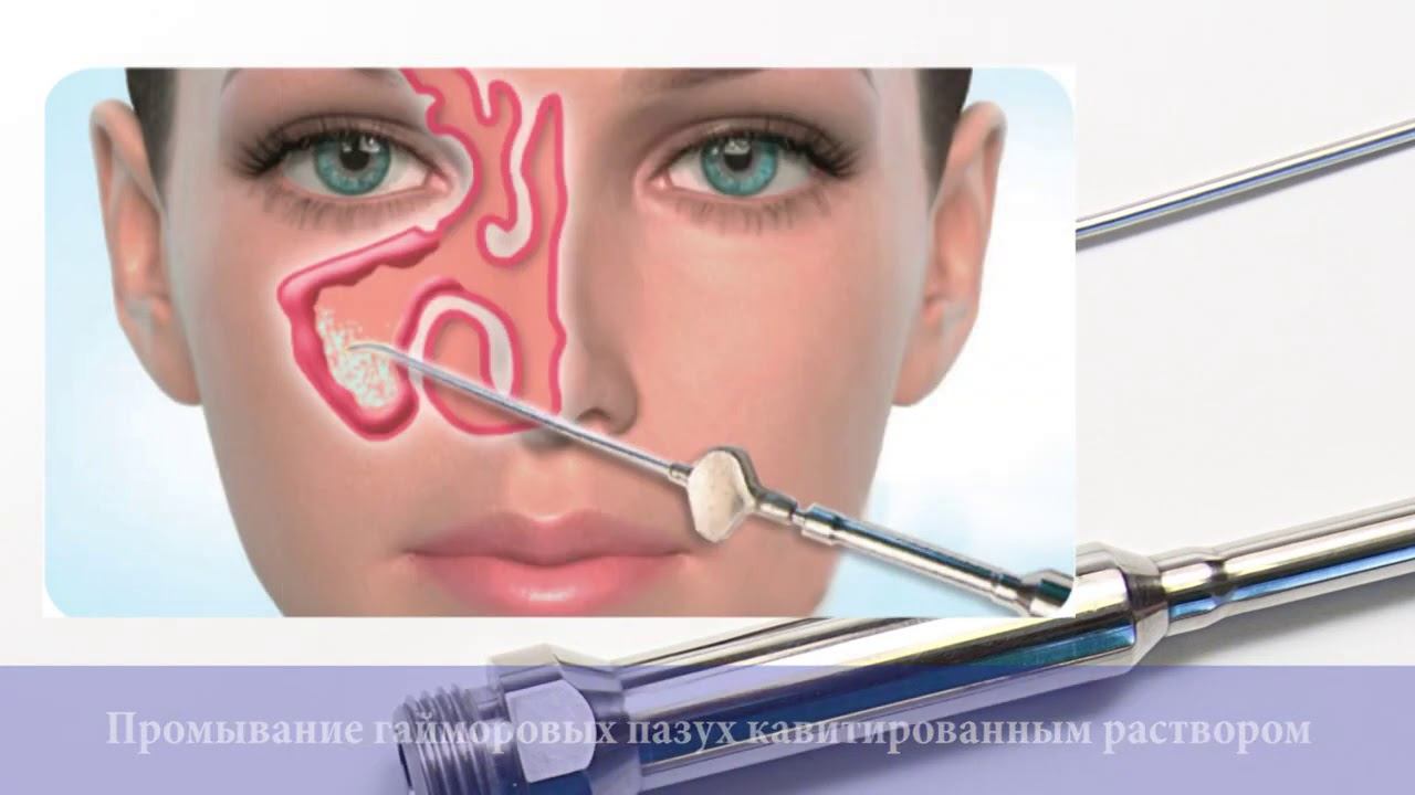 Видеоруководство по применению аппаратов серии АК100 в оториноларингологии