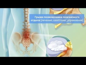 Восстановление при грыже | Проверьте себя | 5 важных поинтов что лечение идет верно | Павел Артемьев