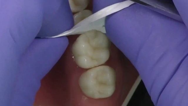 How to easily remove the excess when luting with G-CEM ONE смотреть онлайн