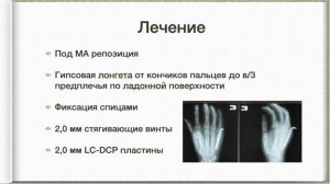 27. Переломы и вывихи пястных костей и фаланг пальцев кисти: диагностика, лечение.
