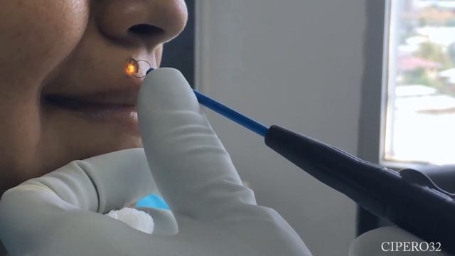 Mole Removal - Right Upper Lip смотреть онлайн