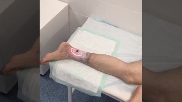 Лечение трофической язвы. Лазер Minel black light ME2010 смотреть онлайн