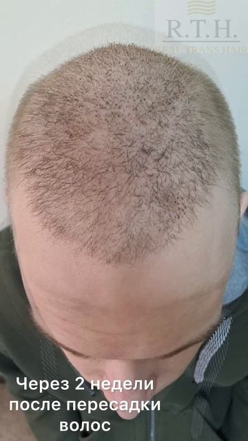 До и через 2 недели после пересадки волос смотреть онлайн