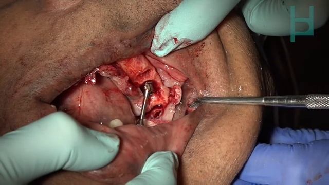 LIVE SURGERY VIDEO - All on 4 with Dr. Sheikh смотреть онлайн