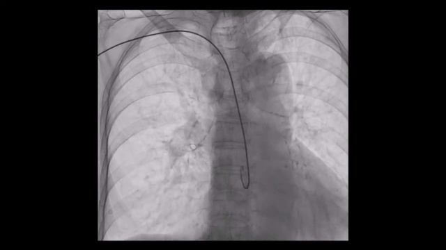 Significant Radial Artery Stenosis смотреть онлайн