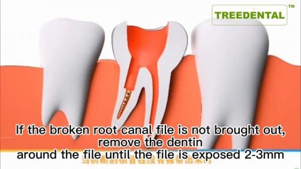 Root Canal File Extractor,Dental Broken File Extractor Root Canal Tool