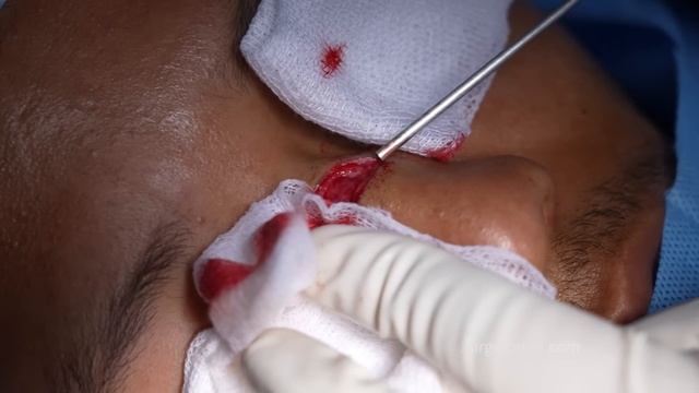 Surgical Scar Removal on Nose | Richardson Face Hospital смотреть онлайн