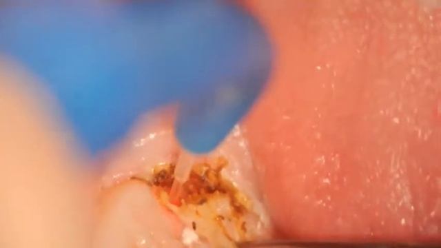 AMD Laser- Operculectomy with Piccaso смотреть онлайн