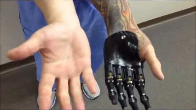 Biyonik Parsiyel El Protezi / Bionic Partial Hand Prosthesis смотреть онлайн