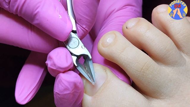 Wrong toenails trimming consequences