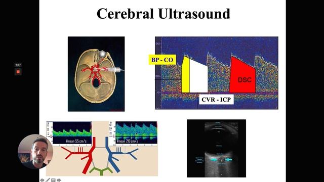 Multimodal monitoring in the neuro-ICU F S Taccone  (IFAD 2020)