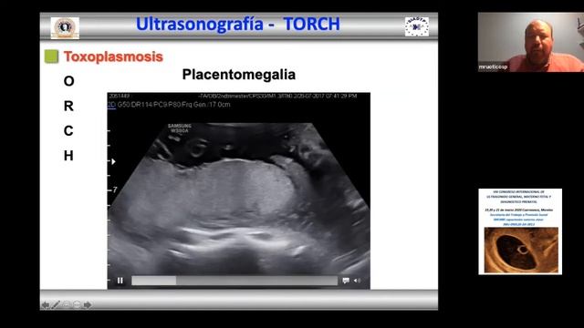 Infecciones Perinatales TORCH смотреть онлайн