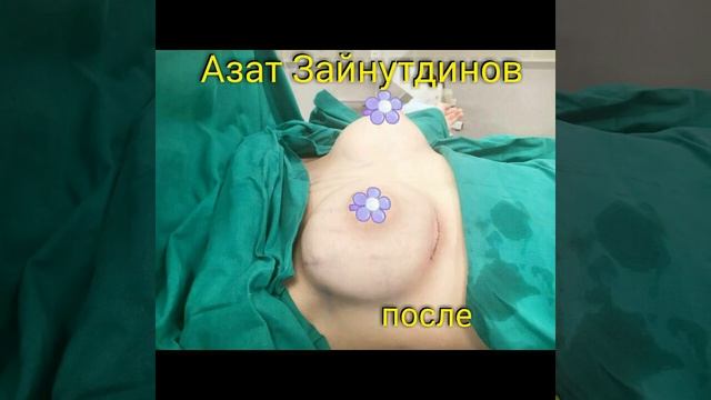 Маммопластика, круглые импланты 245 мл #пластический хирургКазань#маммопластика#красиваягрудь# смотреть онлайн