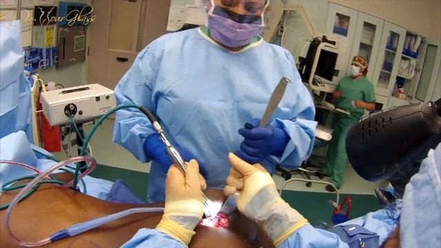 How Butt Implants Procedure Can Make Your Buttocks Shapelier? | Dr.Cortes смотреть онлайн