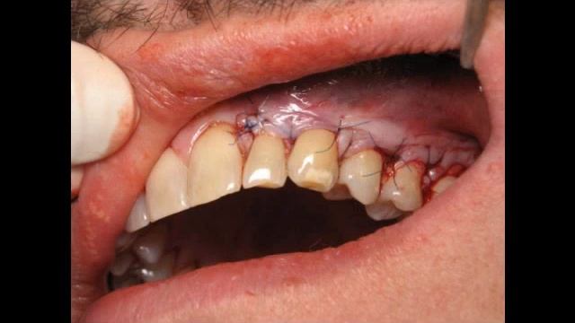 ★ Gingivitis Gel | Learn How I Cured My Gingivitus Permanently Without Surgery! смотреть онлайн