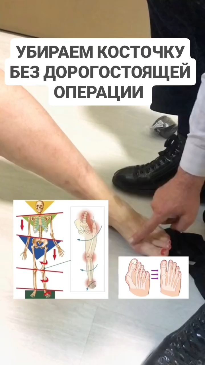 Вальгус - это следствие плоской стопы, которую нужно поставить и удержать в правильной геометрии смотреть онлайн