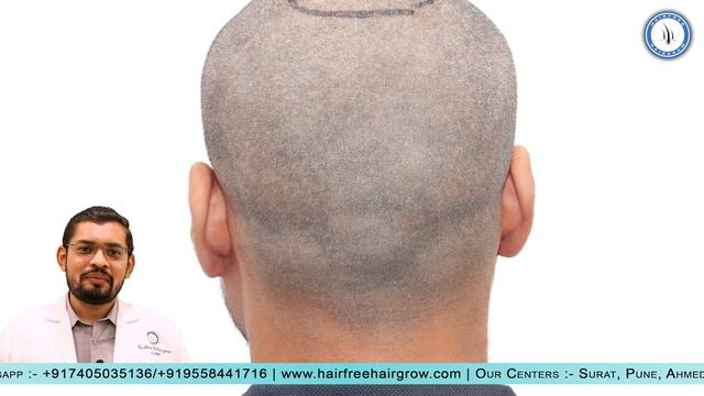 Donor Area Assessment & Grafts Estimation -By Dr. Jinkal Kunjadiya (Part-1) | Hair Transplant Clini смотреть онлайн