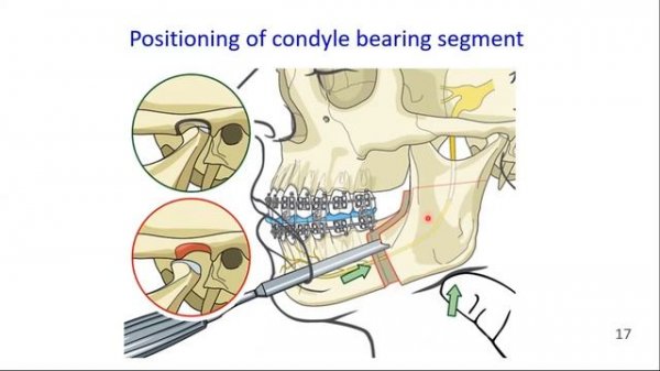 Obwegeser | Dal Pont | BSSO | Bilateral Sagittal Split Osteotomy | Orthognathic Surgery