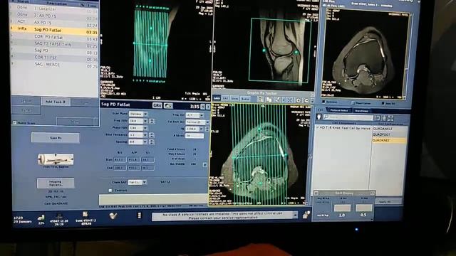 Knee Joint MRI scan protocol, positioning and planning on GE 1.5 Tesla | Live Demo in English. смотреть онлайн