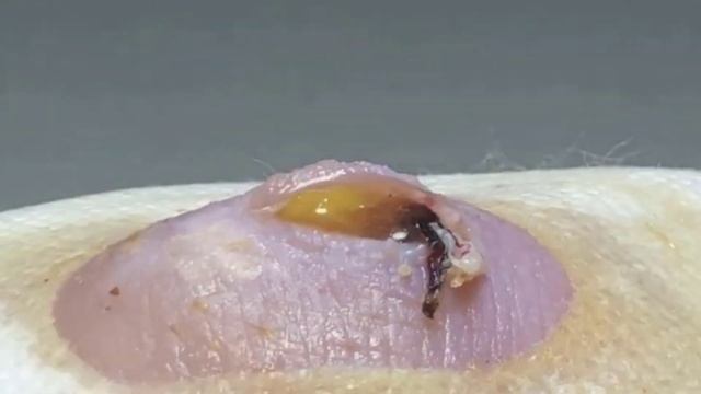 The Loan nguyen spa the Dr Lee pimple popper, trim them front with fungus 0606 3737 pimple Zit pops смотреть онлайн