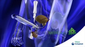 ТРЕХКОМПОНЕНТНЫЙ ФАЛЛОПРОТЕЗ. Как работает? Coloplast penile prosthesis Titan ЭРЕКТИЛЬНАЯ ДИСФУНКЦИ