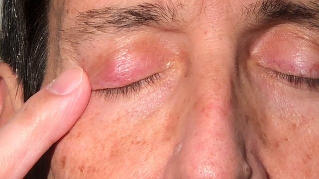 Chalazion and Styes | Dr. Alan Mendelsohn смотреть онлайн