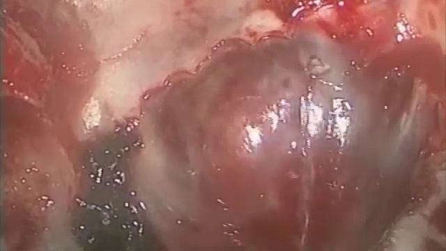 Endoscopic Resection of Pituitary Adenoma смотреть онлайн