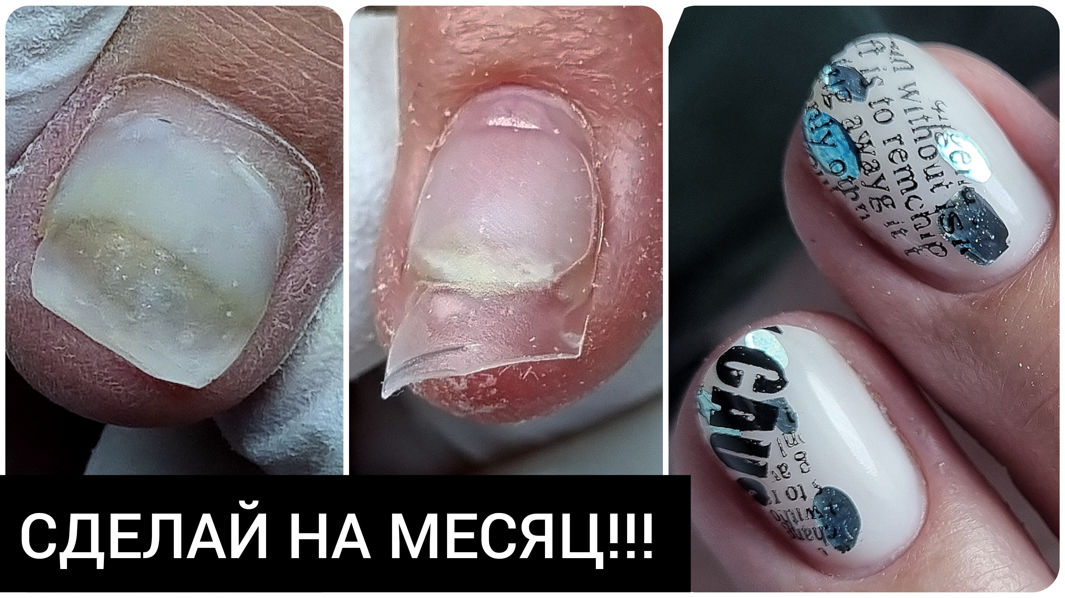 ПОСПАЛЕНИЕ под онихолизисом