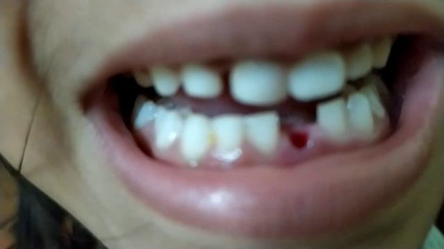 Baby Milk Tooth Fallout Today | Mother Daughter Bond | Alcove Prayag смотреть онлайн