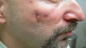 Dr. Timothy Jochen Talks About Scar Treatment Solutions