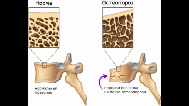 Остеопороз как укрепить костную ткань в домашних условиях смотреть онлайн
