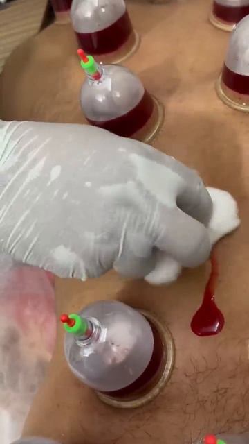 Kzhijama & leech therapy centre #kzhijama #hijama #cupping #cup #drkazi #leechtherapy #bharat #indi смотреть онлайн
