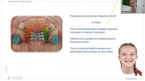 Ортодонтия. Аппарат Хаас