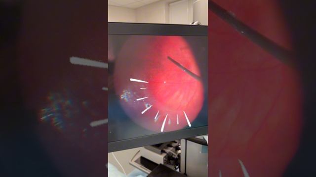 Операция на сетчатке: взгляд изнутри! Важное видео от нашего хирурга Унгурьянова О.В. смотреть онлайн