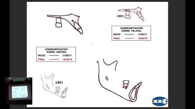 2da Parte. Extracción de Incisivo Inferior con el Dr.Jordán Sol. смотреть онлайн