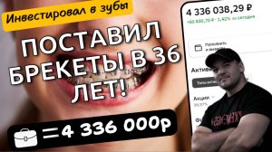 Зачем я поставил брекеты в 36 лет, сколько мне это стоило и какой имею результат спустя 1 год!