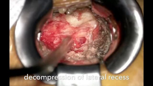 Microsurgical Decompression Lumbar Spinal Stenosis смотреть онлайн