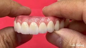 Циркониевый протез на all-on-4