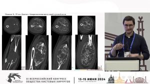 Карасев А.Л.: опухоли предплечья. Современный подход в лечении.