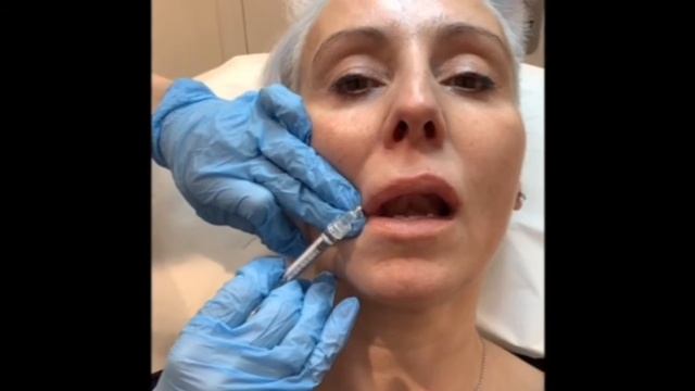 Belotero Lip filler treatment смотреть онлайн