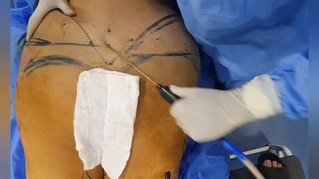 Lower Back Lift +Liposuction|Back Lift |Liposuction |Body Reshaping |Dr Amin Yousaf Lahore Pakistan смотреть онлайн