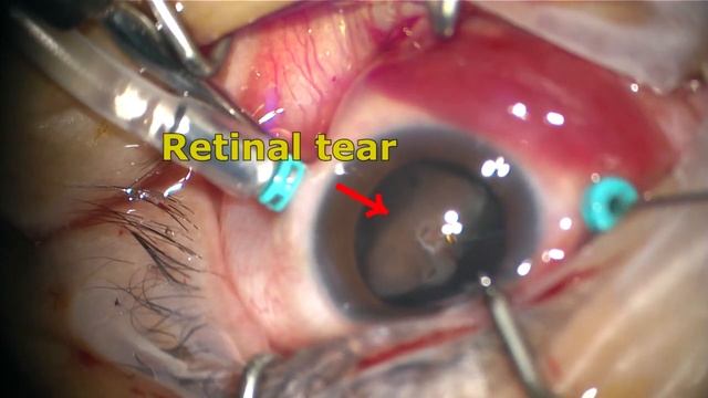 Dislocated Multifocal IOL (Surgeon : HI-Kim, MD. 김형일) смотреть онлайн