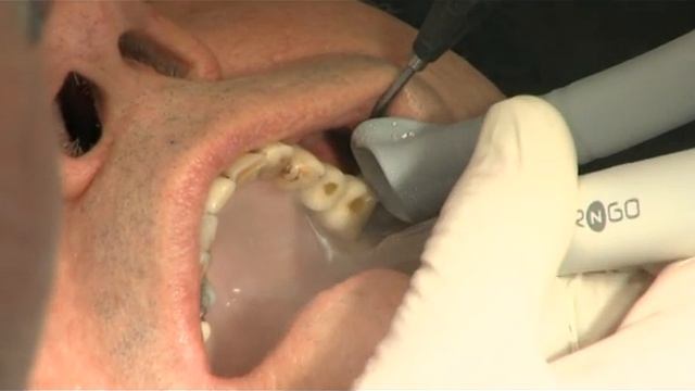 AIR-N-GO PERIO CLINICAL CASE IMPLANTS смотреть онлайн
