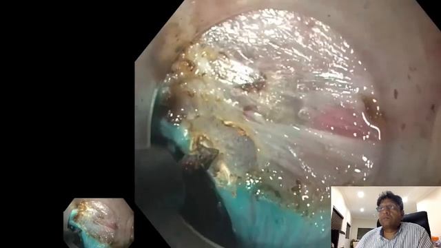 20190213 Oesophageal manometry and Achalasia смотреть онлайн
